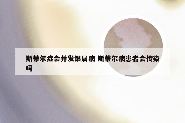 斯蒂尔症会并发银屑病 斯蒂尔病患者会传染吗