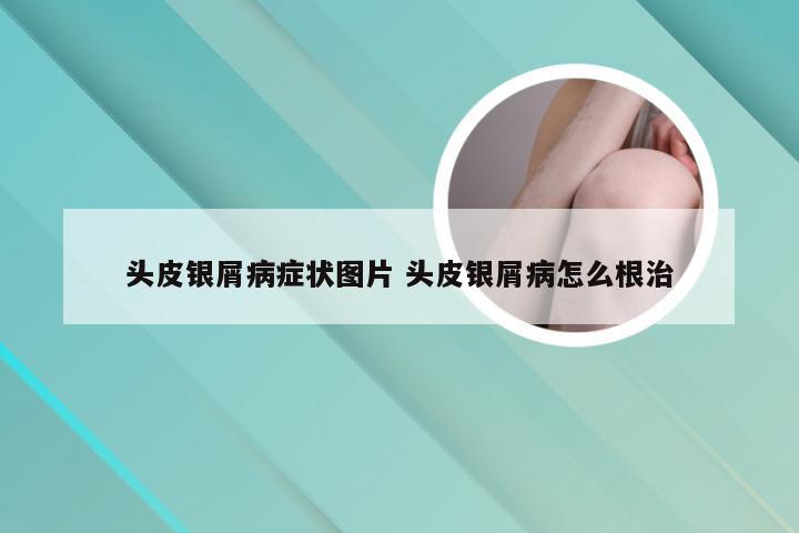头皮银屑病症状图片 头皮银屑病怎么根治