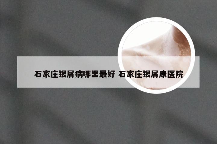 石家庄银屑病哪里最好 石家庄银屑康医院
