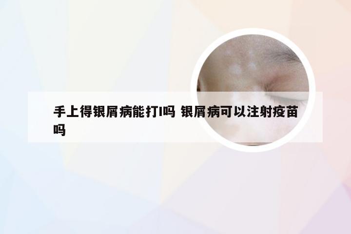 手上得银屑病能打I吗 银屑病可以注射疫苗吗