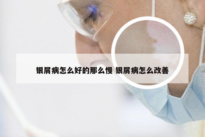 银屑病怎么好的那么慢 银屑病怎么改善