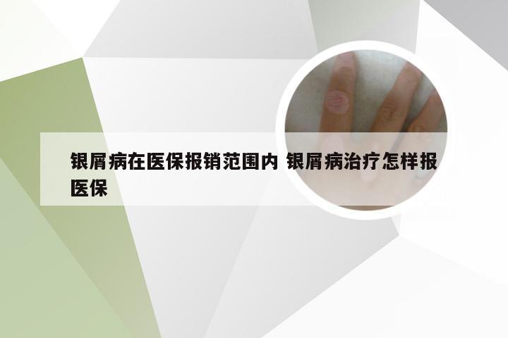 银屑病在医保报销范围内 银屑病治疗怎样报医保