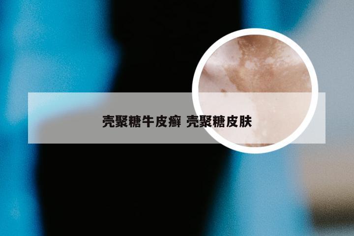 壳聚糖牛皮癣 壳聚糖皮肤