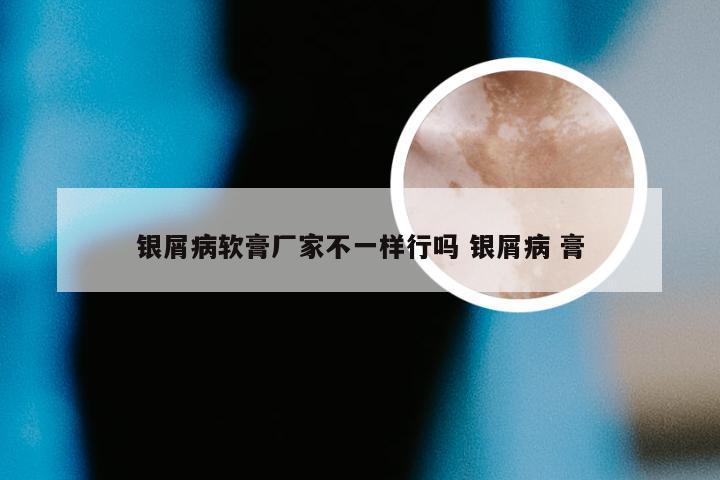 银屑病软膏厂家不一样行吗 银屑病 膏