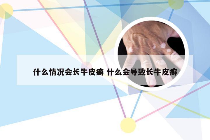 什么情况会长牛皮癣 什么会导致长牛皮癣