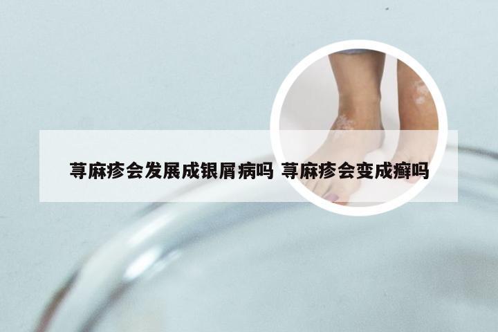 荨麻疹会发展成银屑病吗 荨麻疹会变成癣吗