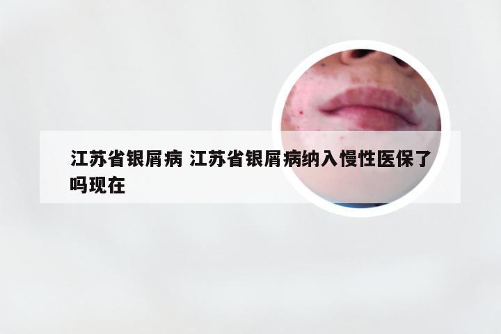 江苏省银屑病 江苏省银屑病纳入慢性医保了吗现在