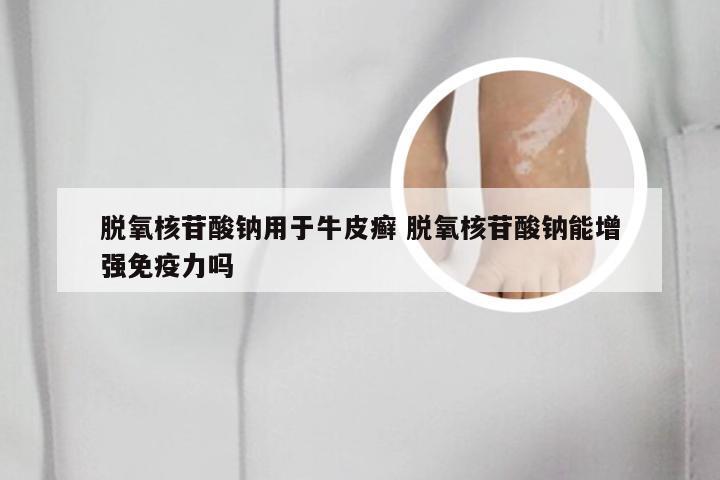 脱氧核苷酸钠用于牛皮癣 脱氧核苷酸钠能增强免疫力吗