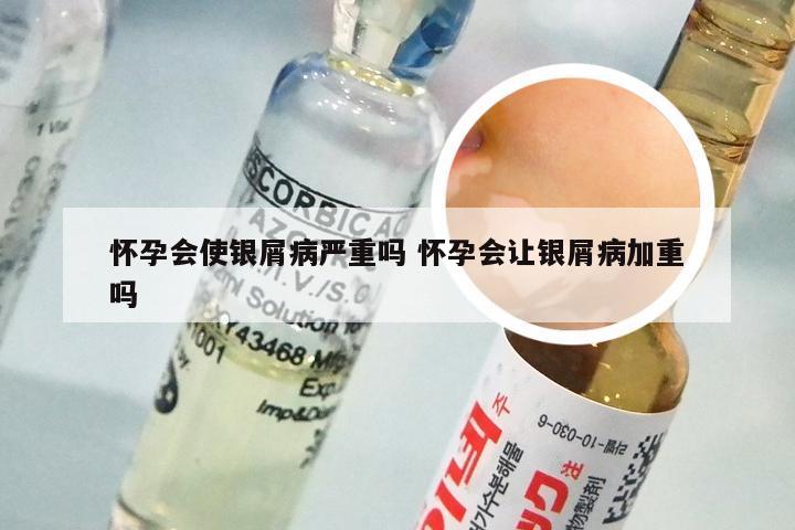 怀孕会使银屑病严重吗 怀孕会让银屑病加重吗
