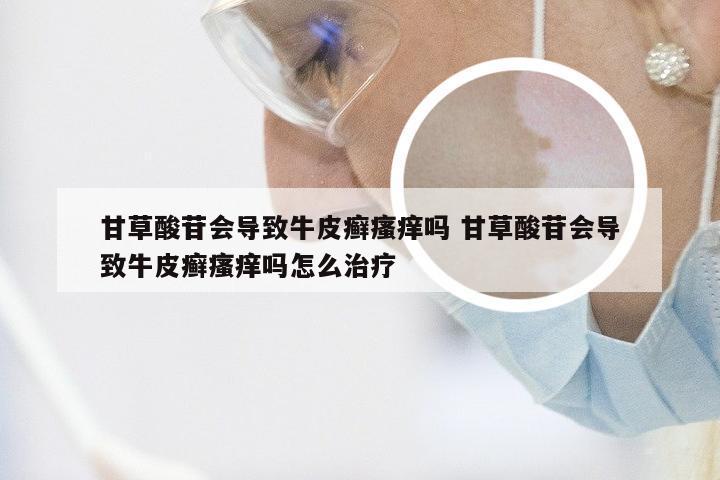 甘草酸苷会导致牛皮癣瘙痒吗 甘草酸苷会导致牛皮癣瘙痒吗怎么治疗