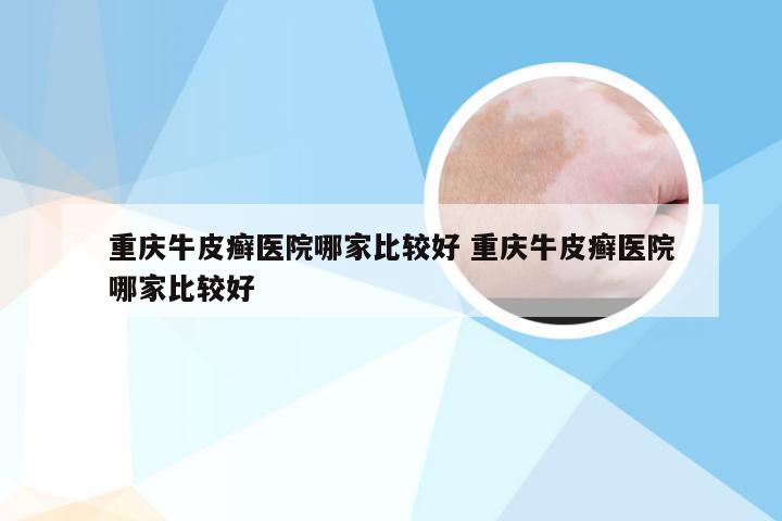 重庆牛皮癣医院哪家比较好 重庆牛皮癣医院哪家比较好