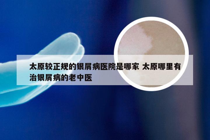 太原较正规的银屑病医院是哪家 太原哪里有治银屑病的老中医