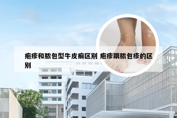疱疹和脓包型牛皮癣区别 疱疹跟脓包疹的区别