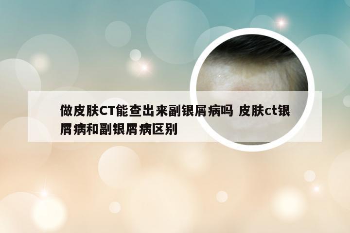 做皮肤CT能查出来副银屑病吗 皮肤ct银屑病和副银屑病区别