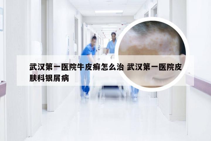 武汉第一医院牛皮癣怎么治 武汉第一医院皮肤科银屑病