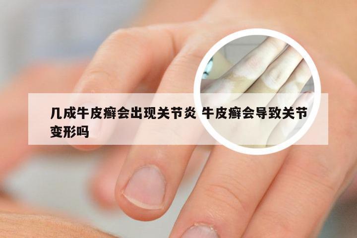 几成牛皮癣会出现关节炎 牛皮癣会导致关节变形吗