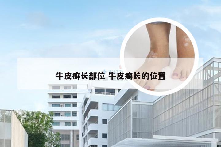 牛皮癣长部位 牛皮癣长的位置