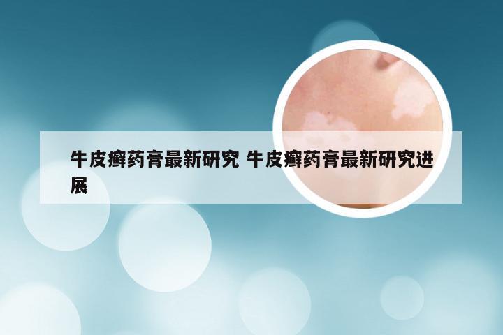 牛皮癣药膏最新研究 牛皮癣药膏最新研究进展
