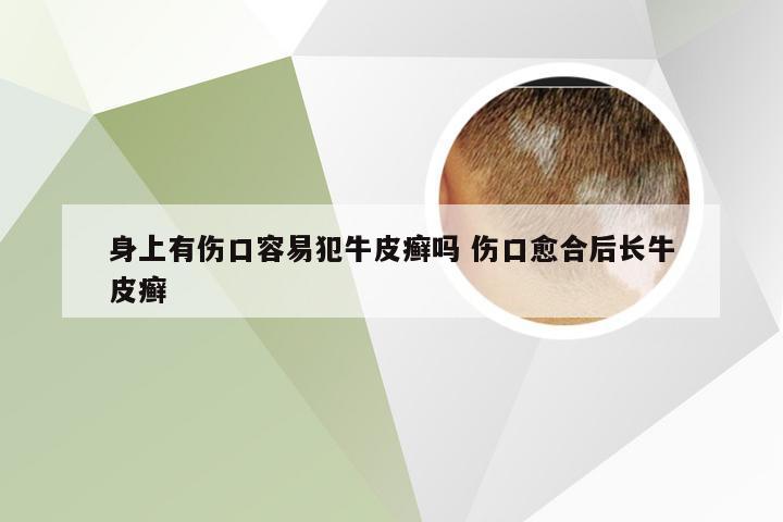 身上有伤口容易犯牛皮癣吗 伤口愈合后长牛皮癣