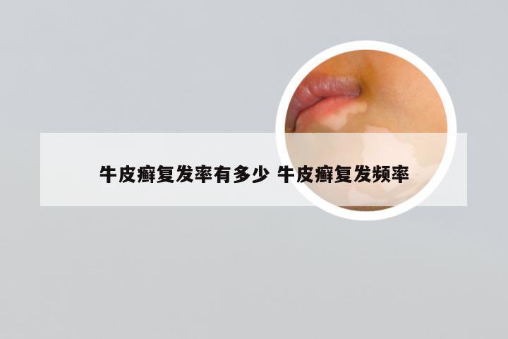 牛皮癣复发率有多少 牛皮癣复发频率