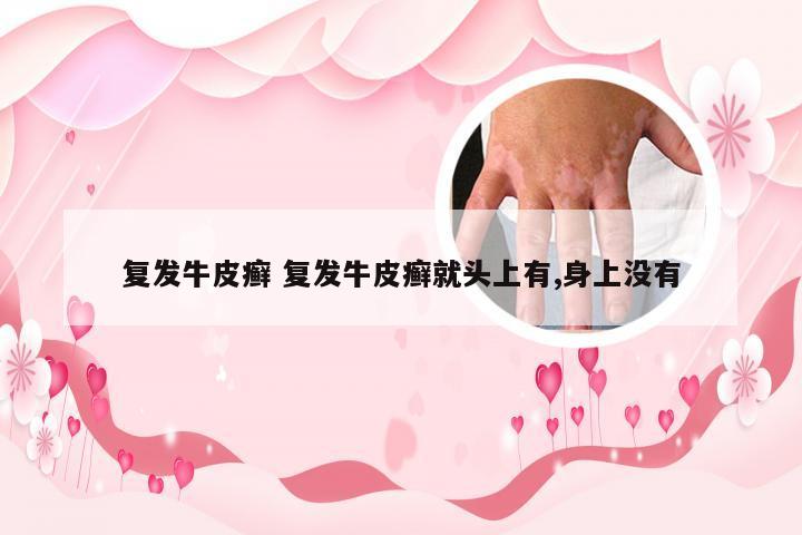 复发牛皮癣 复发牛皮癣就头上有,身上没有
