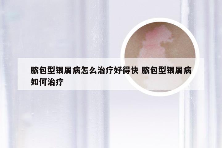 脓包型银屑病怎么治疗好得快 脓包型银屑病如何治疗