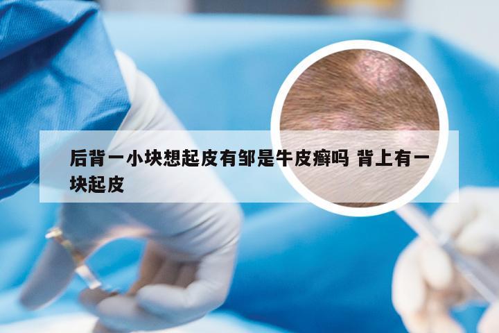 后背一小块想起皮有邹是牛皮癣吗 背上有一块起皮