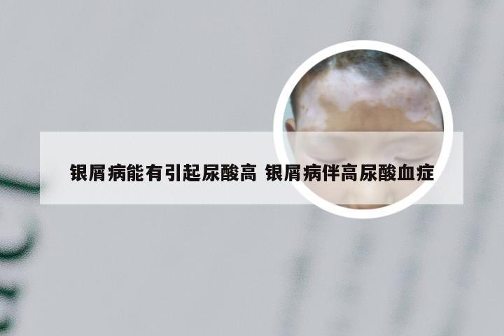 银屑病能有引起尿酸高 银屑病伴高尿酸血症