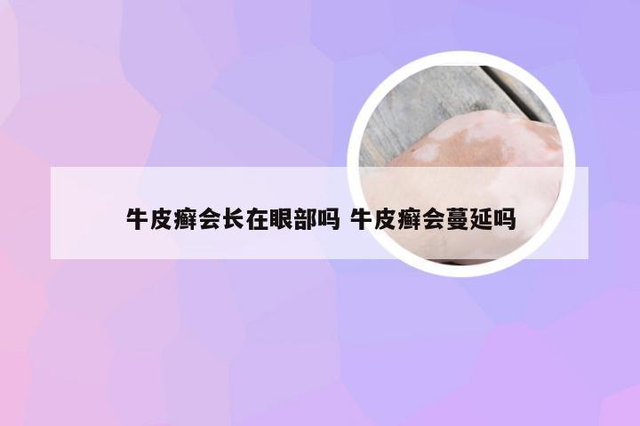 牛皮癣会长在眼部吗 牛皮癣会蔓延吗