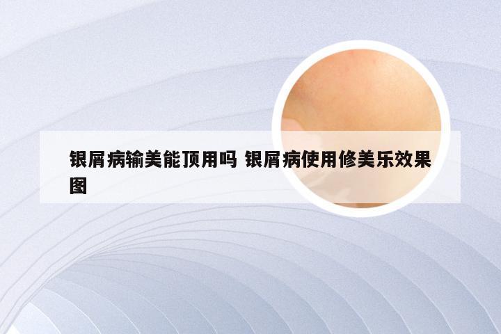 银屑病输美能顶用吗 银屑病使用修美乐效果图