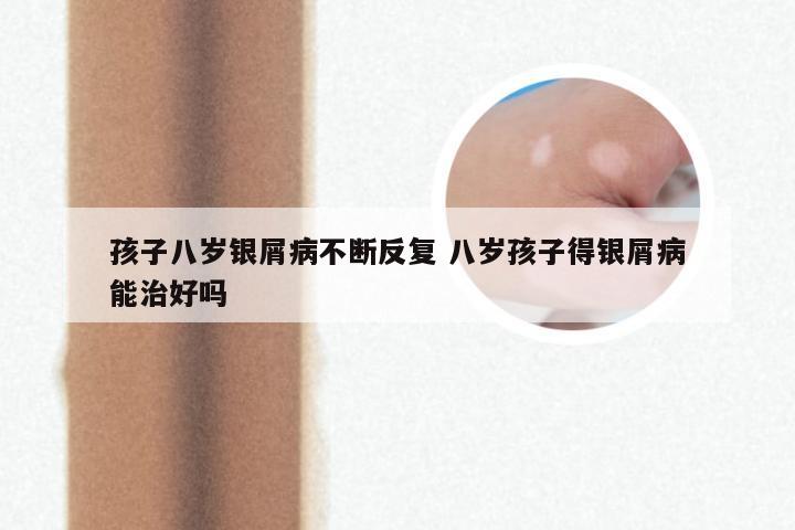 孩子八岁银屑病不断反复 八岁孩子得银屑病能治好吗