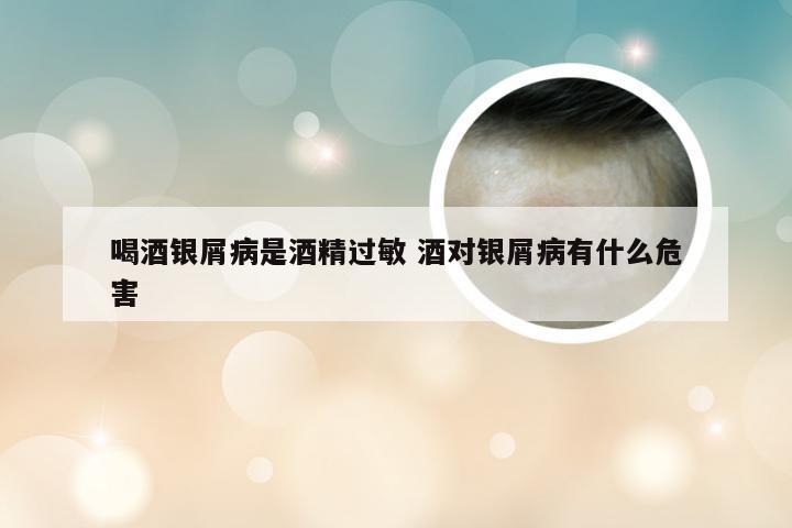 喝酒银屑病是酒精过敏 酒对银屑病有什么危害