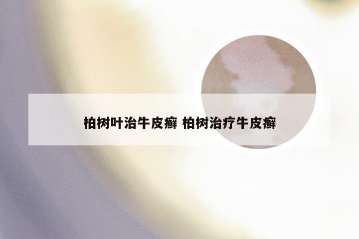 柏树叶治牛皮癣 柏树治疗牛皮癣