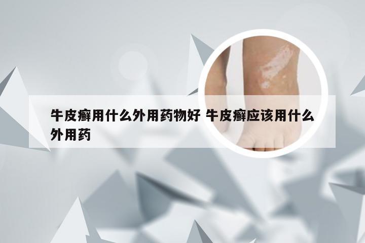 牛皮癣用什么外用药物好 牛皮癣应该用什么外用药