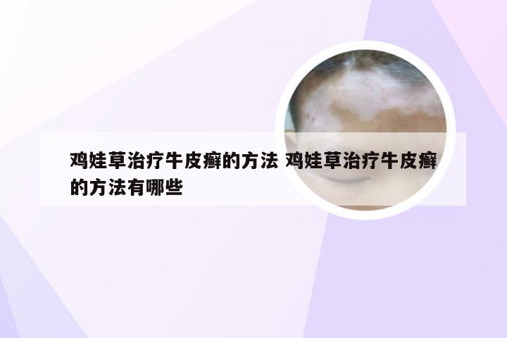 鸡娃草治疗牛皮癣的方法 鸡娃草治疗牛皮癣的方法有哪些