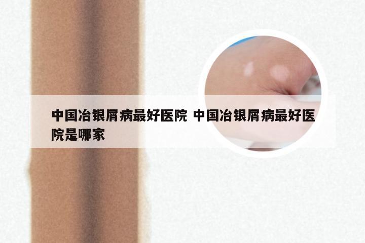 中国冶银屑病最好医院 中国冶银屑病最好医院是哪家