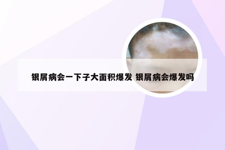 银屑病会一下子大面积爆发 银屑病会爆发吗