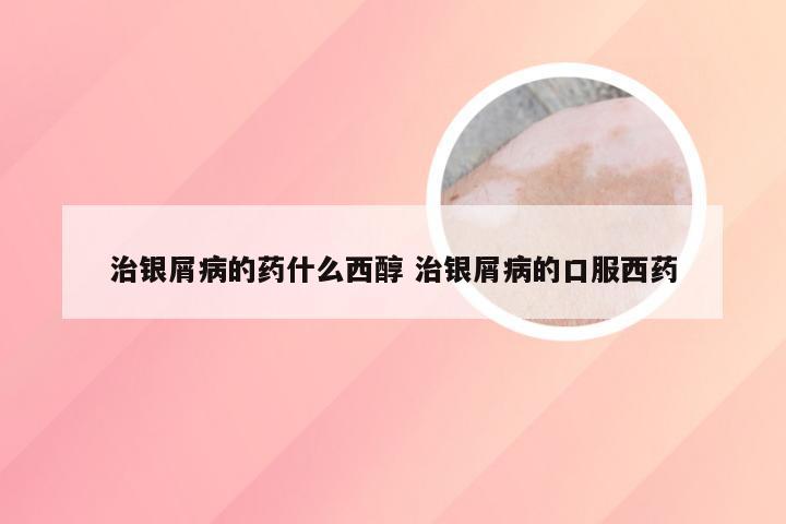 治银屑病的药什么西醇 治银屑病的口服西药