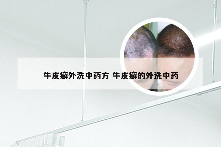 牛皮癣外洗中药方 牛皮癣的外洗中药