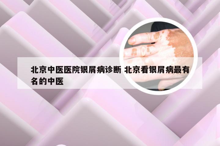 北京中医医院银屑病诊断 北京看银屑病最有名的中医