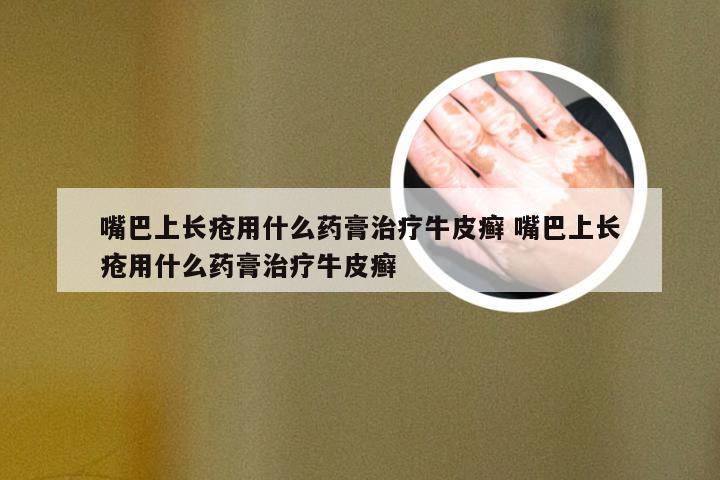嘴巴上长疮用什么药膏治疗牛皮癣 嘴巴上长疮用什么药膏治疗牛皮癣