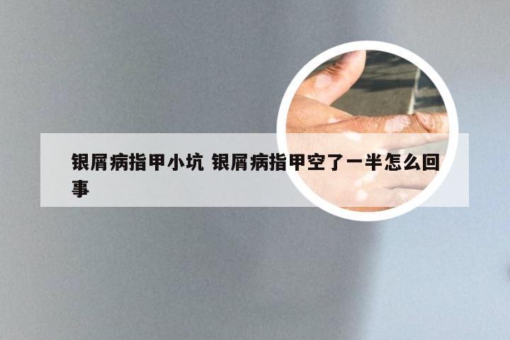 银屑病指甲小坑 银屑病指甲空了一半怎么回事