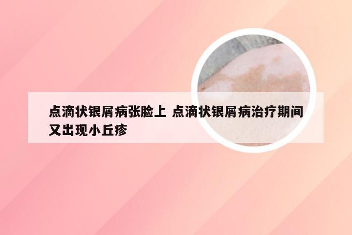 点滴状银屑病张脸上 点滴状银屑病治疗期间又出现小丘疹