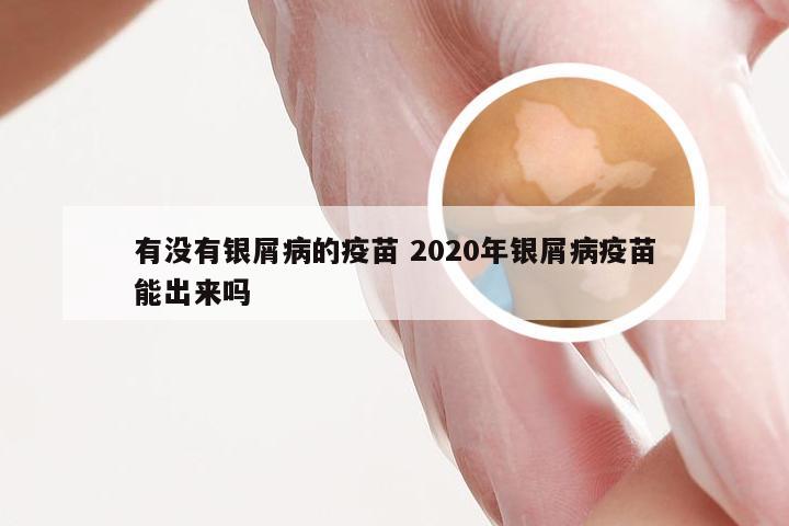 有没有银屑病的疫苗 2020年银屑病疫苗能出来吗