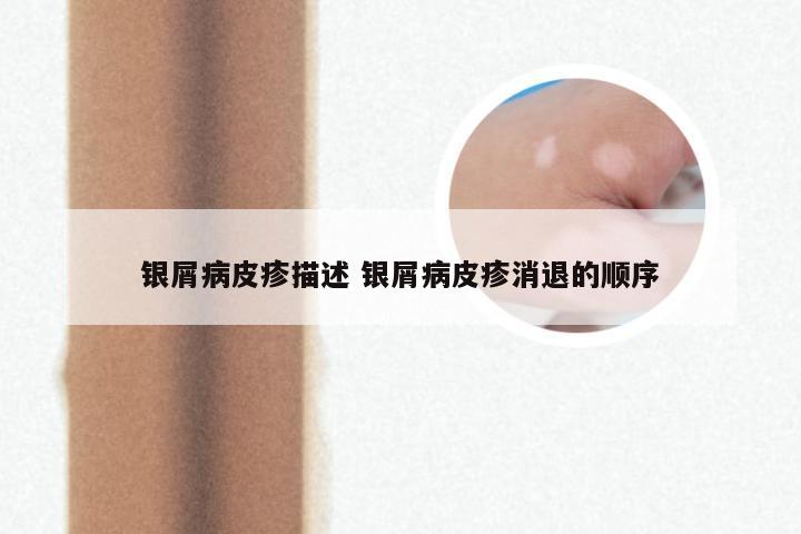 银屑病皮疹描述 银屑病皮疹消退的顺序