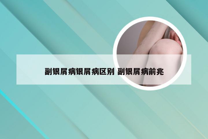 副银屑病银屑病区别 副银屑病前兆