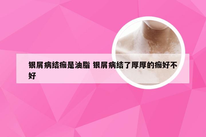 银屑病结痂是油脂 银屑病结了厚厚的痂好不好
