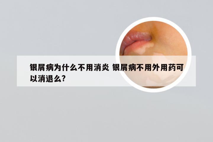 银屑病为什么不用消炎 银屑病不用外用药可以消退么?