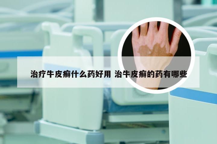 治疗牛皮癣什么药好用 治牛皮癣的药有哪些