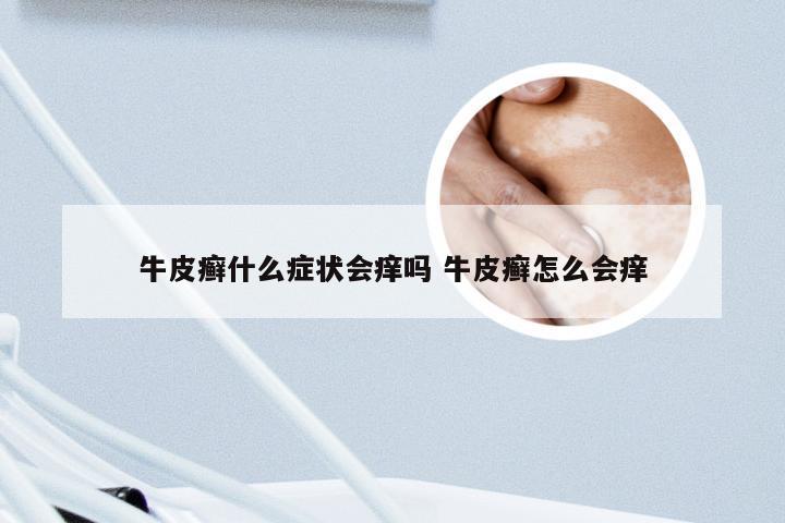 牛皮癣什么症状会痒吗 牛皮癣怎么会痒